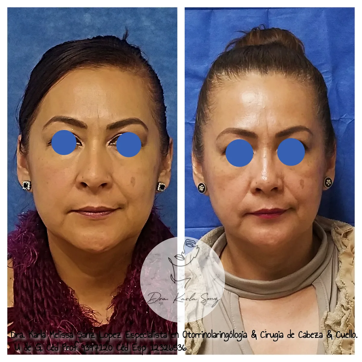 Resultado clínico de Blefaroplastia - Dra. Karla Sanz