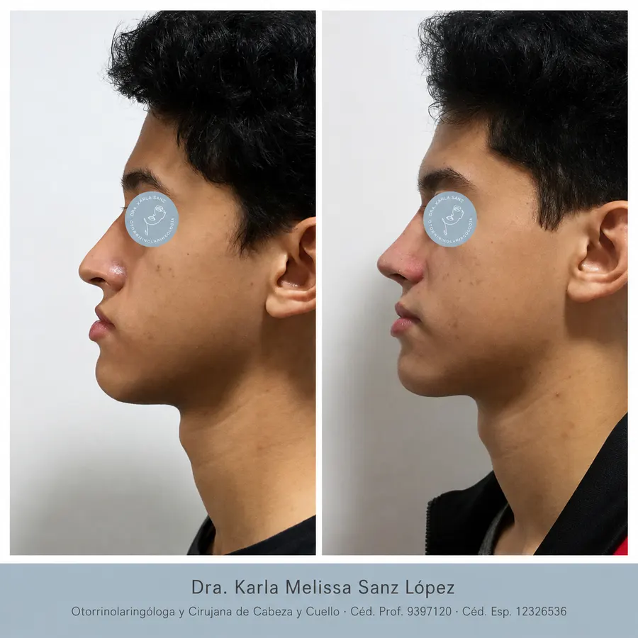 Rinoplastia en Guadalajara - Caso 1: Antes de la cirugía, vista frontal