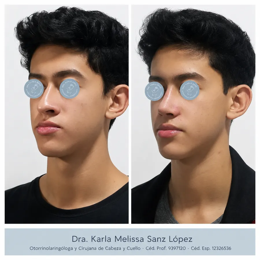 Rinoplastia en Guadalajara - Caso 1: Resultados postoperatorios, vista frontal