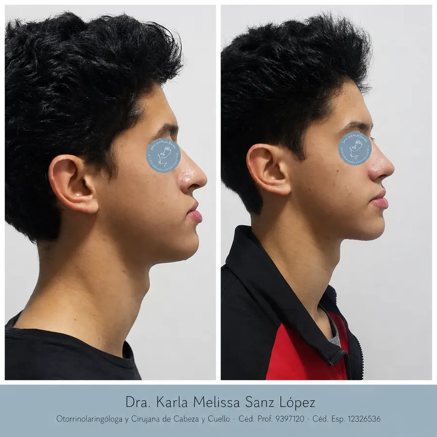Rinoplastia en Guadalajara - Caso 1: Resultados postoperatorios, vista de perfil lateral