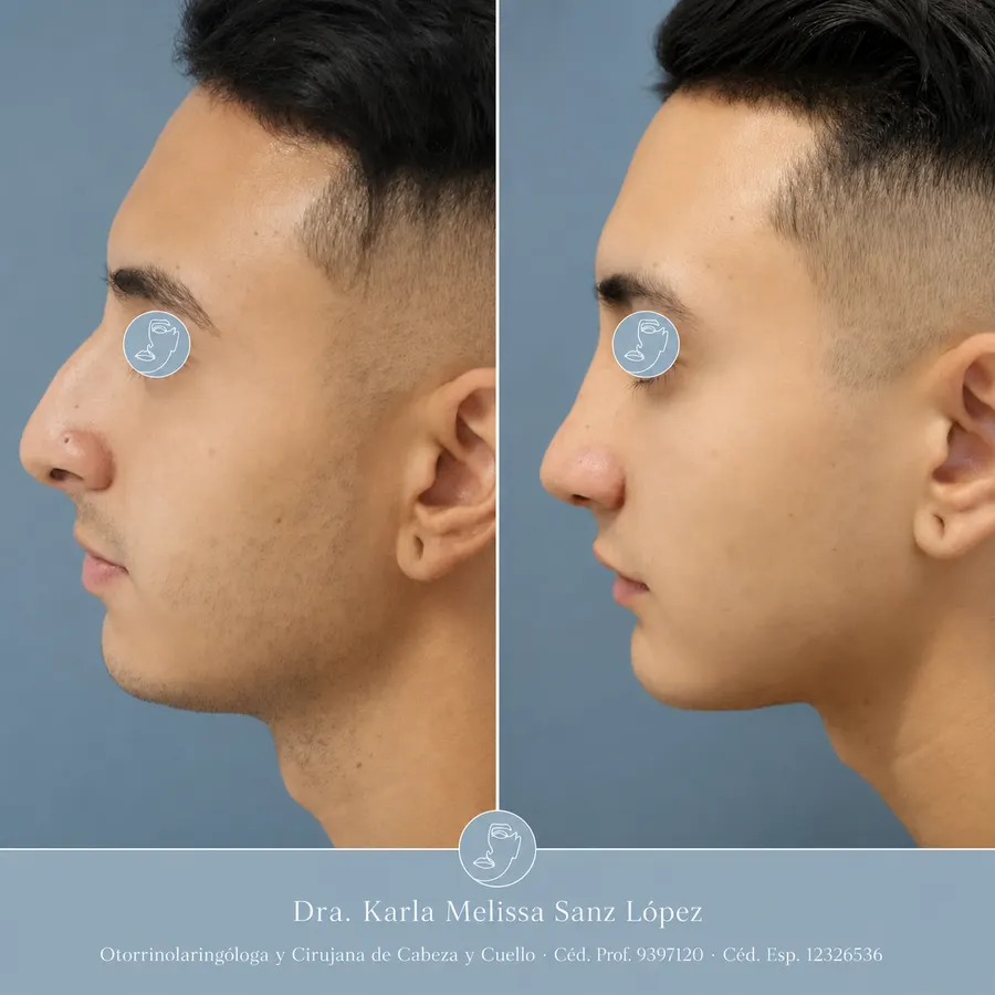 Rinoplastia en Guadalajara - Caso 2: Antes de la cirugía, vista de perfil lateral