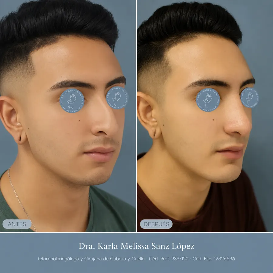 Rinoplastia en Guadalajara - Caso 2: Resultados postoperatorios, vista de perfil lateral