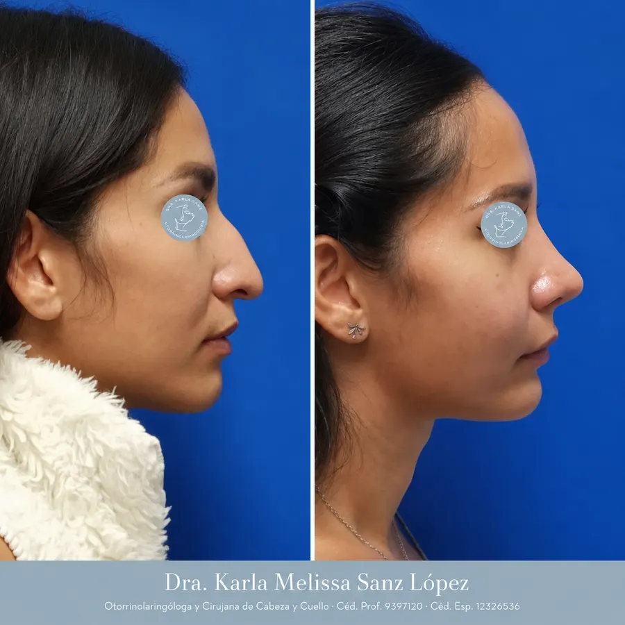 Rinoplastia en Guadalajara - Caso 3: Antes de la cirugía, vista frontal
