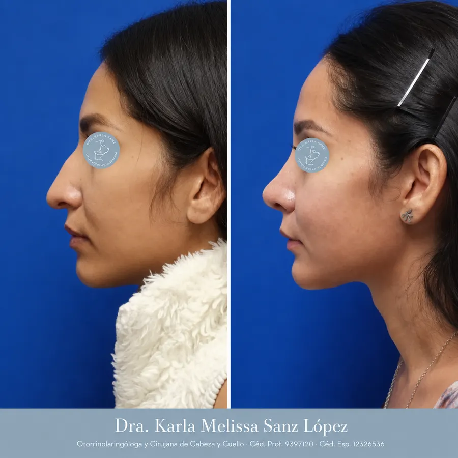 Rinoplastia en Guadalajara - Caso 3: Resultados postoperatorios, vista frontal