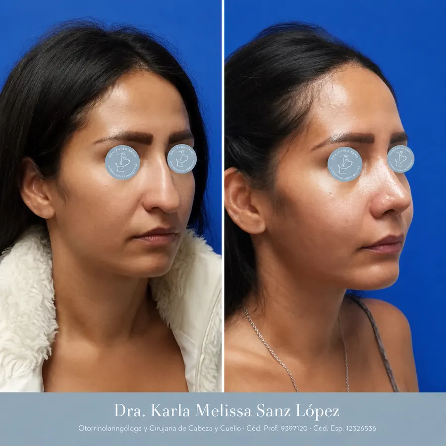 Rinoplastia en Guadalajara - Caso 3: Antes de la cirugía, vista de perfil lateral