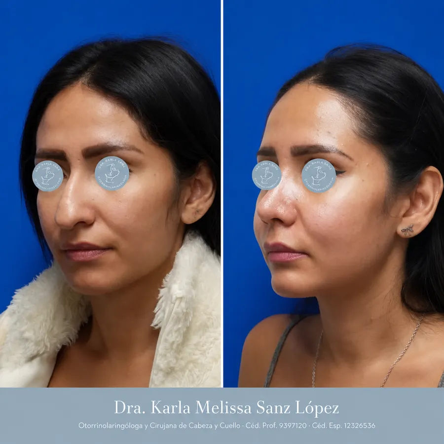 Rinoplastia en Guadalajara - Caso 3: Resultados postoperatorios, vista de perfil lateral