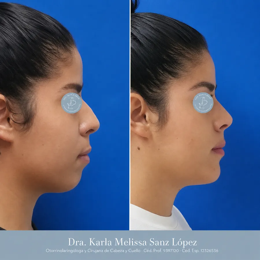 Rinoplastia en Guadalajara - Caso 4: Antes de la cirugía, vista de perfil lateral