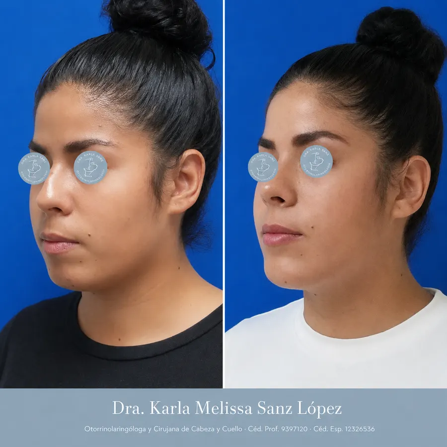 Rinoplastia en Guadalajara - Caso 4: Resultados postoperatorios, vista de perfil lateral