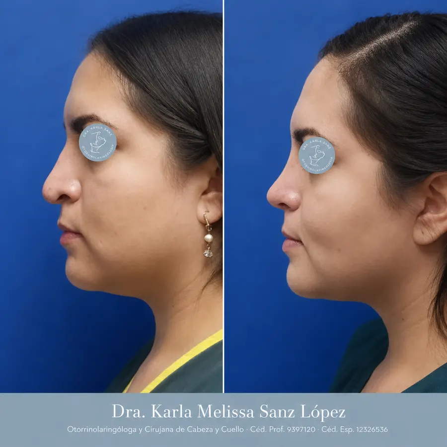 Rinoplastia en Guadalajara - Caso 5: Antes de la cirugía, vista de perfil lateral