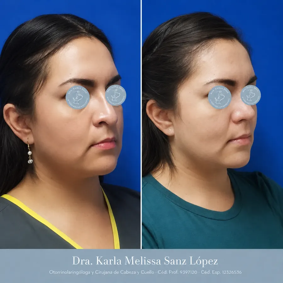 Rinoplastia en Guadalajara - Caso 5: Resultados postoperatorios, vista de perfil lateral