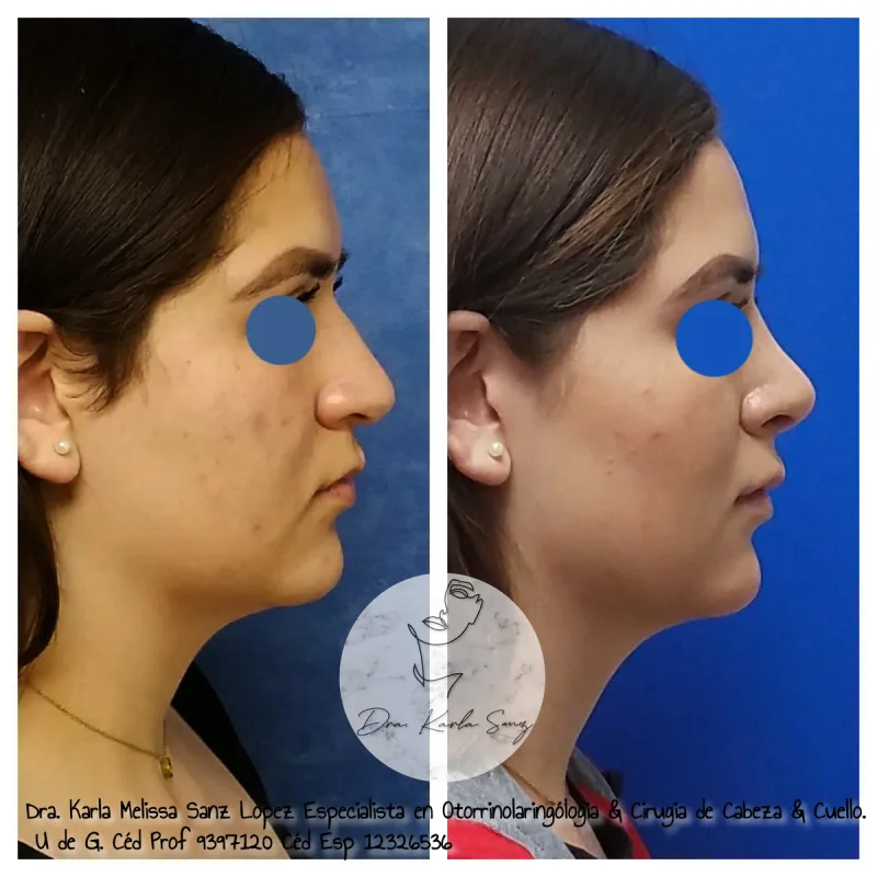 Resultado clínico de Rinoseptoplastia - Dra. Karla Sanz